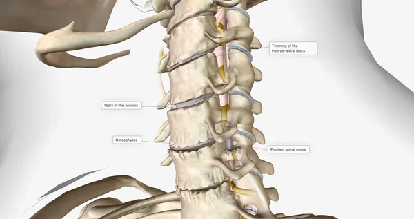 Cervical disc degeneration, or cervical disc disease, is a process that occurs naturally with age. 3D rendering