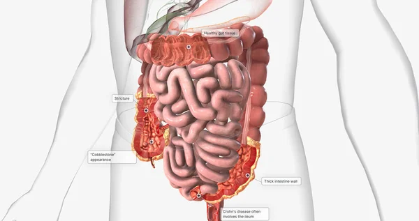 Crohns disease is a type of chronic inflammatory bowel disease. 3D rendering