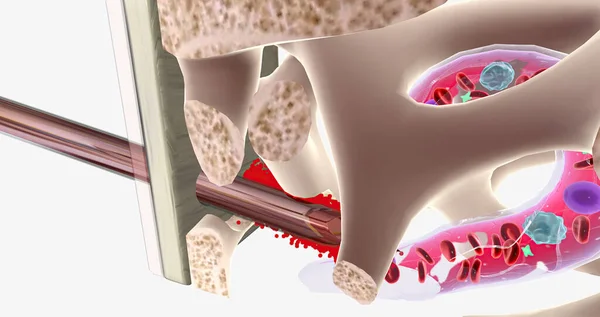 During a bone marrow aspiration, a needle goes through the hip bone and extracts the liquid marrow. 3D rendering