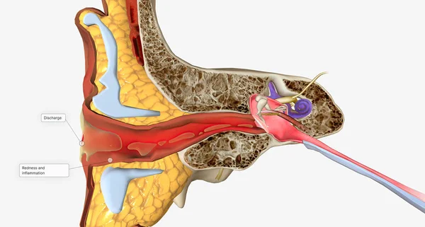 Outer Ear Infection Also Called Otitis Externa Rendering —  Fotos de Stock