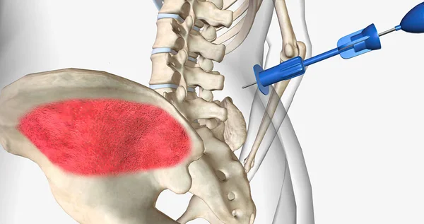 Bone marrow aspiration is a procedure in which a liquid bone marrow sample is collected and tested. 3D rendering