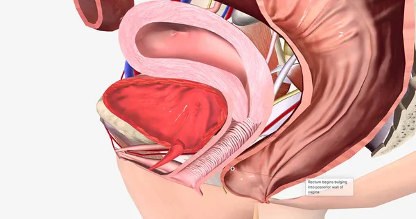 Grade 1 is usually used to describe a rectocele where the rectum has just begun to swell from the back wall of the vagina 3D rendering.