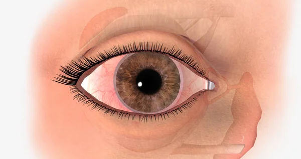 Dry eye is a common condition that results from poor nourishment of the eye.3D rendering