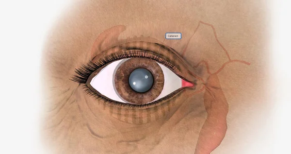 A cataract is the progressive clouding of the lens of the eye accompanied by vision problems. 3D rendering