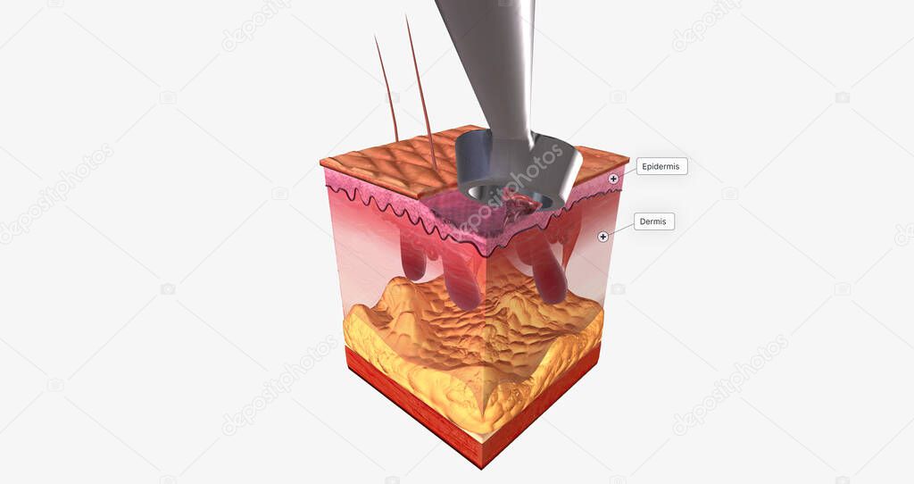 El curetaje y la electrodesecación Close Up 3D renderizado 2023