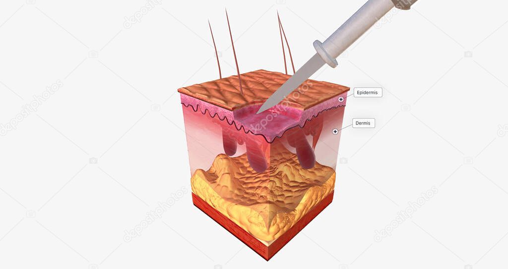 El curetaje y la electrodesecación Close Up 3D renderizado 2023
