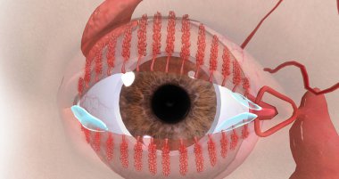 Blepharitis is a chronic inflammation of the eyelids characterized by irritation, redness, watering.3D rendering