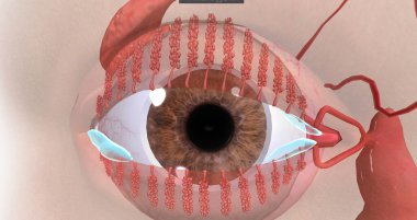 Blepharitis is a chronic inflammation of the eyelids characterized by irritation, redness, watering.3D rendering clipart