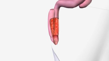 Pouchitis, ülseratif kolit veya diğer hastalıkları tedavi etmek için ameliyat sırasında oluşan bir kesede oluşan iltihaplanmadır..