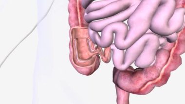 Intussusception hayati tehlike arz eden bir hastalıktır ve bağırsağın bir kısmı teleskop gibi kıvrılıp bir bölümünün başka bir bölümün içine kaymasıyla meydana gelir.