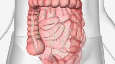 Disbiyoz, bakteri bileşimindeki bir dengesizlik, bakteriyel metabolik faaliyetlerdeki değişiklikler veya bağırsak içindeki bakteri dağılımındaki değişikliklerle tanımlanır..