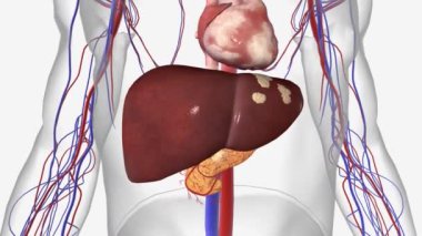 2. Aşama Pankreas Kanseri 3 boyutlu canlandırma