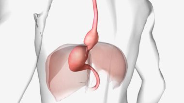 Hiatal fıtık, midenin üst kısmı karnını ve göğsünü ayıran büyük kas boyunca şiştiğinde meydana gelir. .