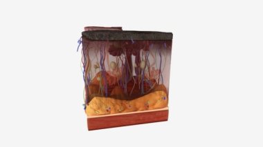 Derideki kalsifilaksi.