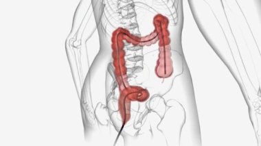 Kolonoskopi, bir doktorun rektum ve kolon içine bakmak için kolonoskop ya da dürbün kullandığı bir işlemdir..