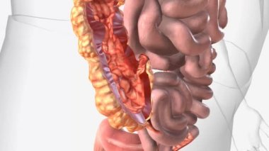 Crohns Hastalığı, Cobblestone görünüşü 3D
