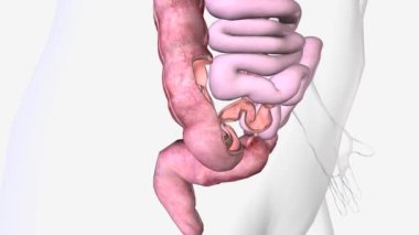 Intussusception hayati tehlike arz eden bir hastalıktır ve bağırsağın bir kısmı teleskop gibi kıvrılıp bir bölümünün başka bir bölümün içine kaymasıyla meydana gelir.