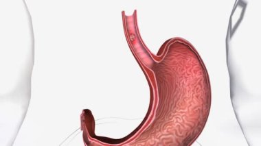 Özofageal Squamous Hücre Karsinom 3d