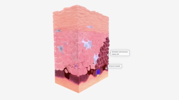 Basal Cell Carcinoma Tissue Stage — Stock Video
