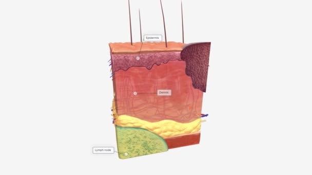 Базальна Клітина Карцинома Сайті Tissue Stage — стокове відео