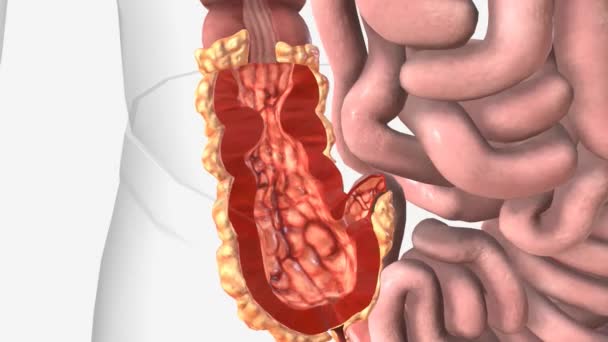Enfermedad Crohn Una Enfermedad Con Inflamación Crónica Etiología Desconocida — Vídeo de stock