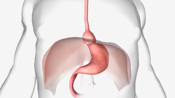 Hiatal Hernia Occurs Upper Part Your Stomach Bulges Large Muscle — Stock Video