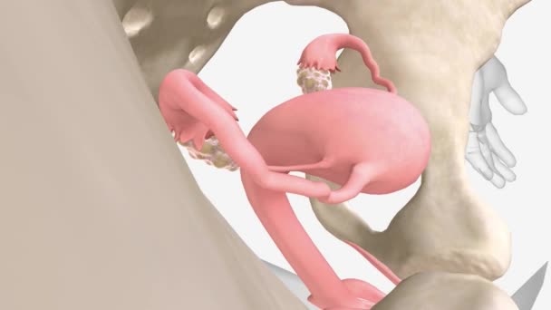 多嚢胞性卵巣症候群は あなたがいくつかの 異常なまたは非常に長い期間を持っている状態です — ストック動画