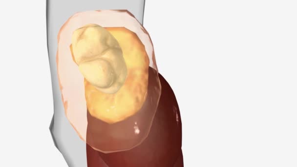 肾上腺意外腺瘤是肾上腺的一个或两个腺体中的一个固体肿块 — 图库视频影像