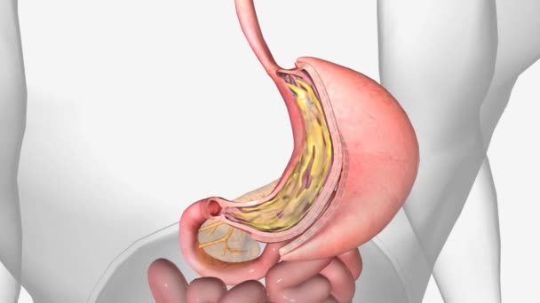 Sleeve Gastrectomy Surgical Procedure Induces Weight Loss Restricting Food Intake — Stock Video