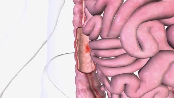 Angiodisplasia Pequeño Vaso Sanguíneo Anormal Tortuoso Dilatado Las Capas Mucosa — Vídeos de Stock
