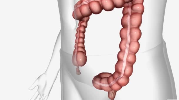 Appendicite Est Quand Votre Appendice Devient Douloureux Enflé Malade — Video