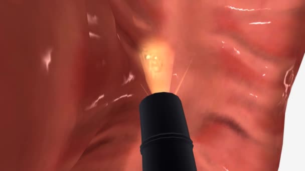 Bei Einer Biopsie Entnimmt Ein Arzt Eine Kleine Menge Gewebe — Stockvideo