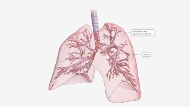 Inflamația Constricția Căilor Respiratorii — Videoclip de stoc
