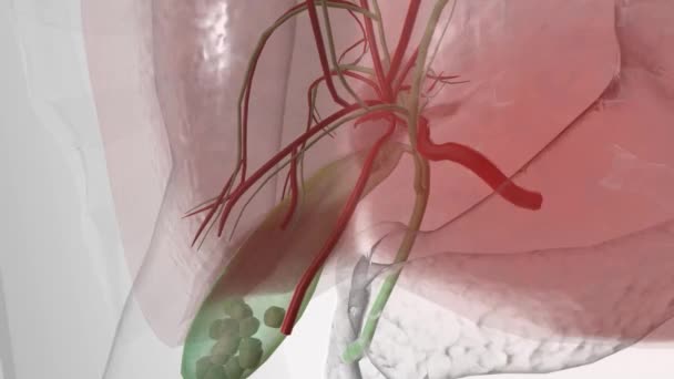 Cholelithiasis Gallstones Cystic Artery Animation — Stock Video