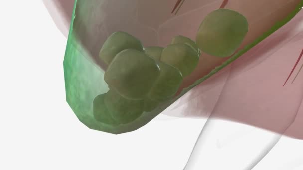 胆石症或胆结石是胆囊中可能形成的消化液的硬化沉积 — 图库视频影像