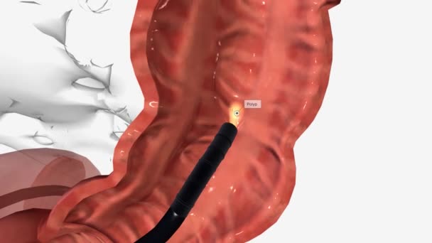 大腸内視鏡検査は 腹部の痛み 直腸出血 慢性下痢や他の腸の可能性のある原因を探るのを助けることができます — ストック動画