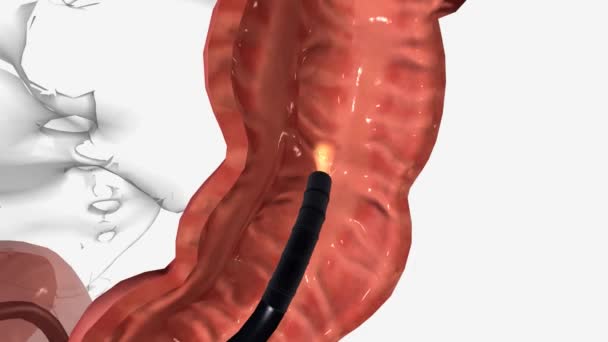 大腸内視鏡検査は 腹部の痛み 直腸出血 慢性下痢や他の腸の可能性のある原因を探るのを助けることができます — ストック動画