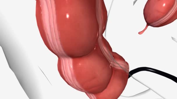 结肠镜检查可以帮助医生探究腹痛 直肠出血 慢性腹泻和其他肠道疾病的可能原因 — 图库视频影像