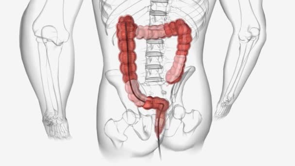 結腸鏡検査とは 直腸や結腸の内部を調べるために 医師が大腸内視鏡やスコープを使用する手順です — ストック動画