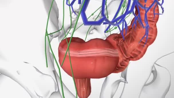 大腸がん0期 現場での結腸がん 異常な細胞は結腸壁の粘膜に見られる — ストック動画