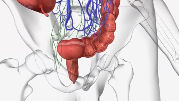 第二阶段结直肠癌分为Iia期 Iib期和Iic期 在Iia阶段 癌症已经通过结肠和直肠的肌肉层扩散 — 图库视频影像