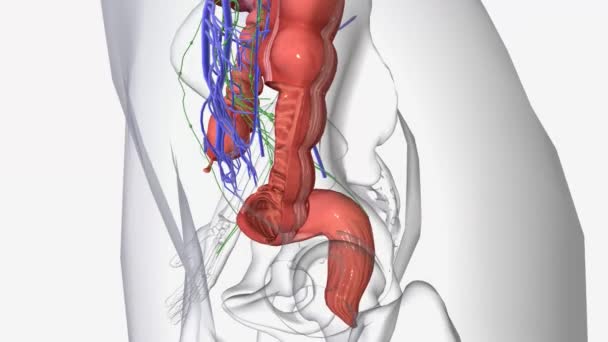 ステージI結腸癌は結腸の内側に限定され 結腸の壁を腹部腔に浸透しません — ストック動画