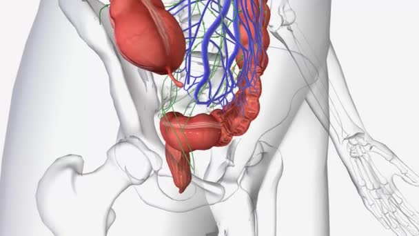 ステージIiiの結腸がんは近くのリンパ節に転移しているが まだ他の部位に転移していない — ストック動画