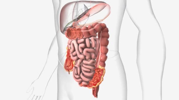 Doença Crohn Tipo Doença Inflamatória Intestinal Dii — Vídeo de Stock