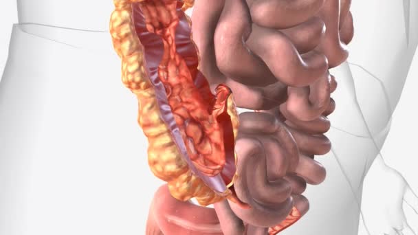 Choroba Crohnsa Wygląd Cobblestone — Wideo stockowe