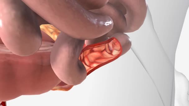 Boala Crohns Boala Crohns Implică Adesea Ileumul — Videoclip de stoc