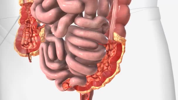 Crohns Disease Thick Intestine Wall — Stock Video