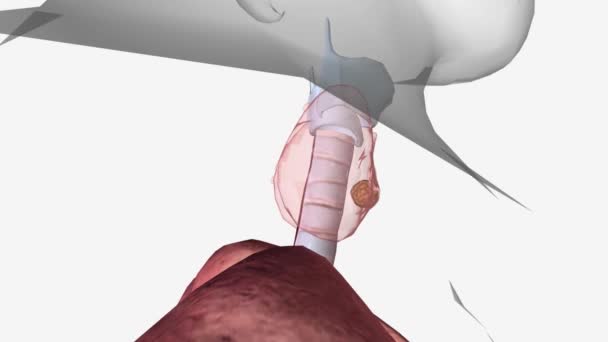 甲状腺癌2期原发性肿瘤的大小不一 癌细胞可能扩散到淋巴结 也可能没有扩散到淋巴结 — 图库视频影像