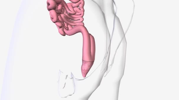 肛门吻合术最常用于治疗慢性溃疡性结肠炎和遗传性疾病 如家族腺瘤性息肉病 — 图库视频影像