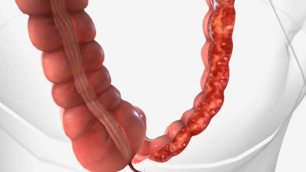 潰瘍性大腸炎は 消化管の炎症や潰瘍 を引き起こす炎症性腸疾患です — ストック動画